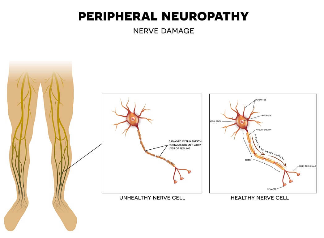 Peripheral neuropathy showing a healthy nerve cell and damaged nerve cell