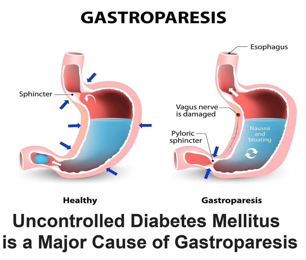 Gastroparesis is mostly caused by peripheral autonomic neuropathy due to uncontrolled diabetes mellitus