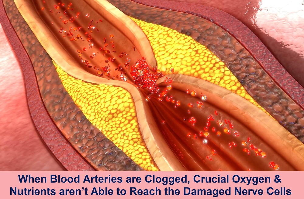 Blood clogged artery is clogged & crucial nutrients & oxygen are not able to reach the damaged nerve cells causing neuropathy