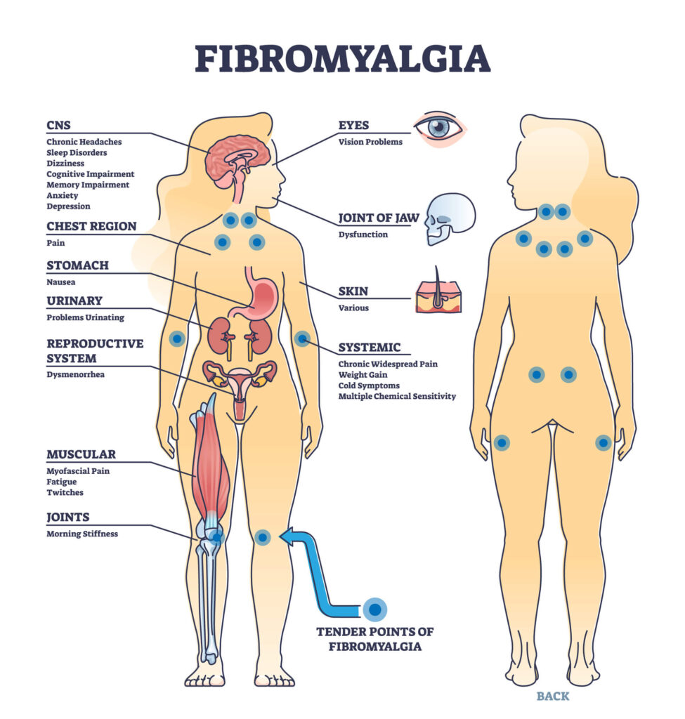 The 18 tender points or pain points associated with fibromyalgia occur in symmetrical pairs from the back of your head to your inner knees.